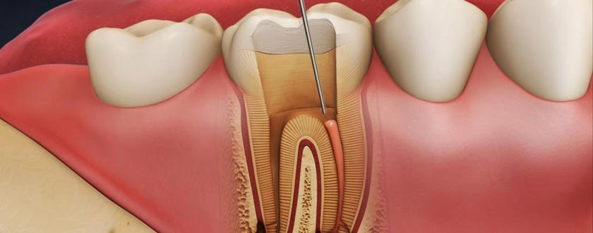 ENDODONTIC