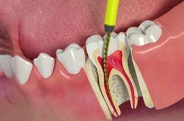 ENDODONTIC